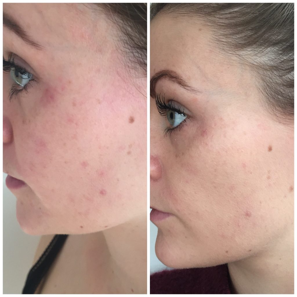 før og efter billede af hud 