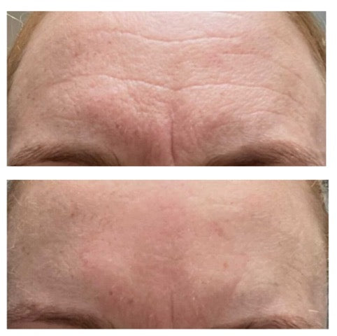 Hudpleje til rynker og fine linjer