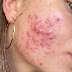 Hudpleje til bumser og udbrud