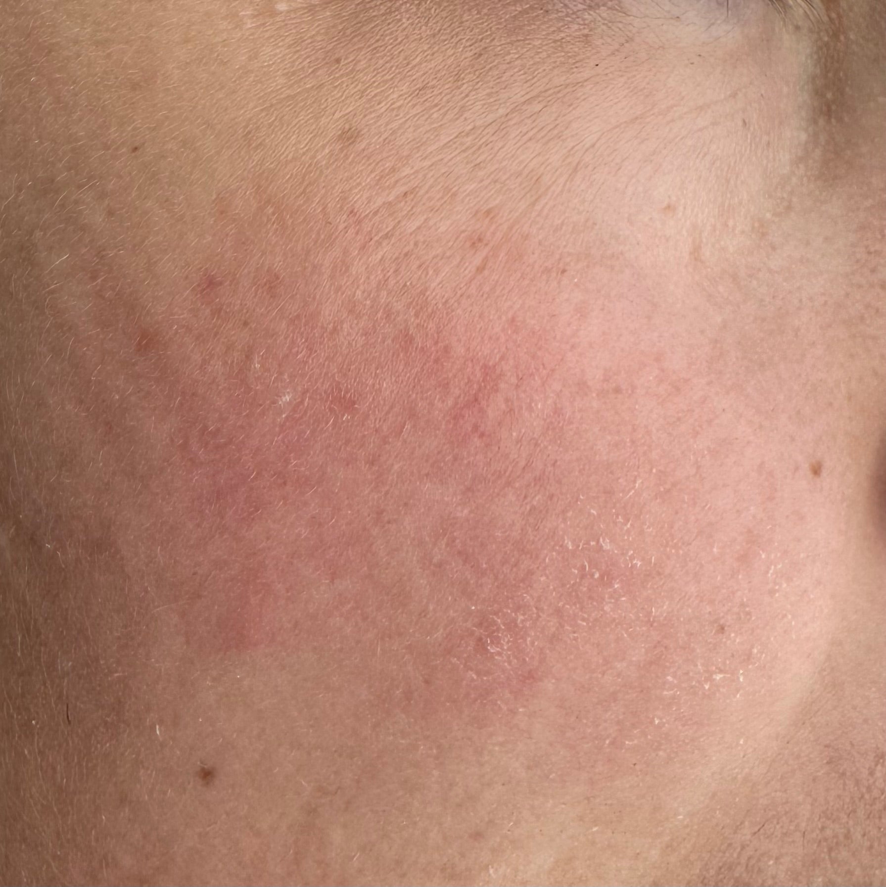 Hudpleje til tør hud