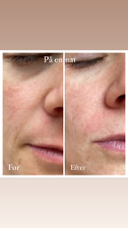 Frownies Lift før og efter